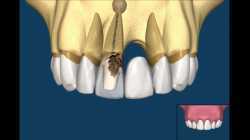 Razlika između metalokeramičkog mosta i implanta