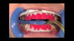 Ambulantno beljenje zuba primenom LED-aktivacione lampe.