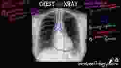 LEARN to Read a Chest Xray in 5 minutes!