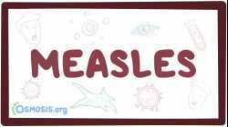 Measles - causes, symptoms, diagnosis, treatment, pathology