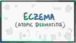 Eczema (atopic dermatitis) - causes, symptoms, diagnosis, treatment, pathology