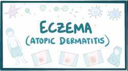 Eczema (atopic dermatitis) - causes, symptoms, diagnosis, treatment, pathology