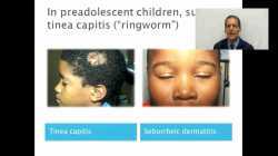 Seborrheic Dermatitis (Dandruff): Diagnosis and Management - OnlineDermClinic