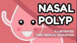 What is Nasal Polyp?