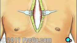 Heart -Coronary Artery Bypass Graft (CABG off-pump) PreOp® Patient Education HD