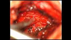 Lumbar herniated disc (L4-L5). Integral procedure