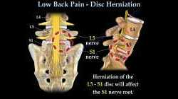 Low Back Pain -   Disc  Herniation ,Sciatica  - Everything You Need To Know - Dr. Nabil Ebraheim