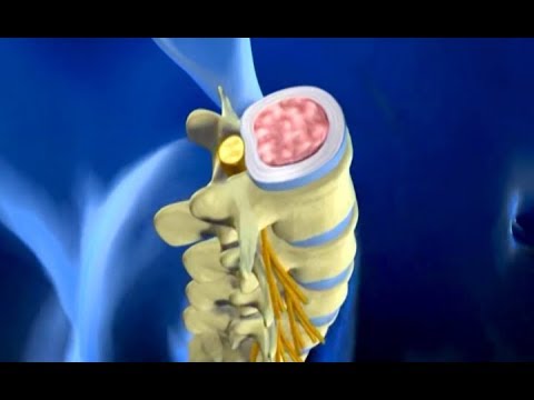 Svijet Zdravlja - Diskus hernija