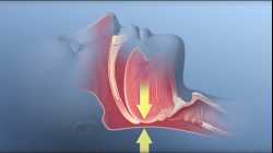 Obstructive Sleep Apnea - Mayo Clinic