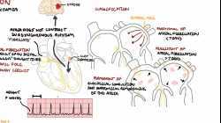 Atrial Fibrillation Overview - ECG, types, pathophysiology, treatment, complications