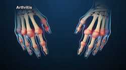 Rheumatoid Arthritis Animation