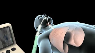 Intubation & Mechanical Ventilation (Ventilator)