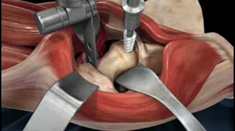 Direct Anterior Approach Hip Replacement